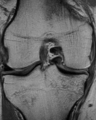 Medial Meniscus Bucket Handle Tear Fragment in Notch